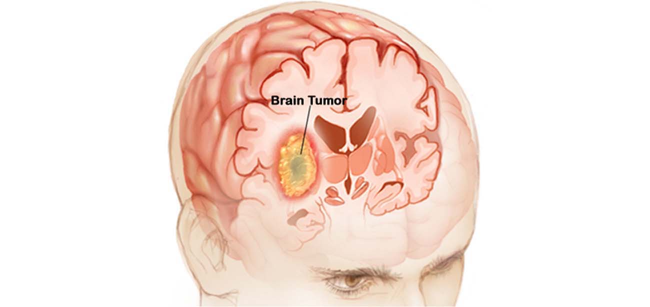 Brain Tumor Surgery done by Dr. Abhijit Kulkarni